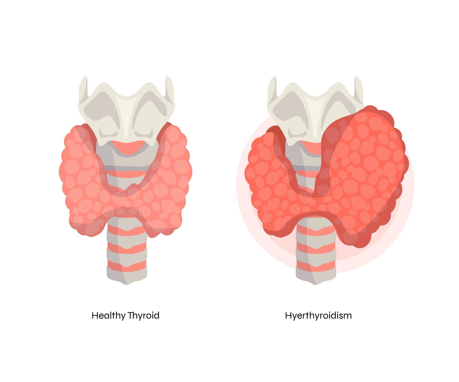 Thyroid Diseases
